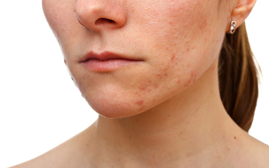 Best Hyperpigmentation Treatment in Cancún, MX: Advanced Solutions for an Even and Radiant Complexion