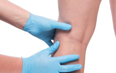Understanding Symptoms and Early Treatment for Deep Vein Thrombosis in Manassas, VA