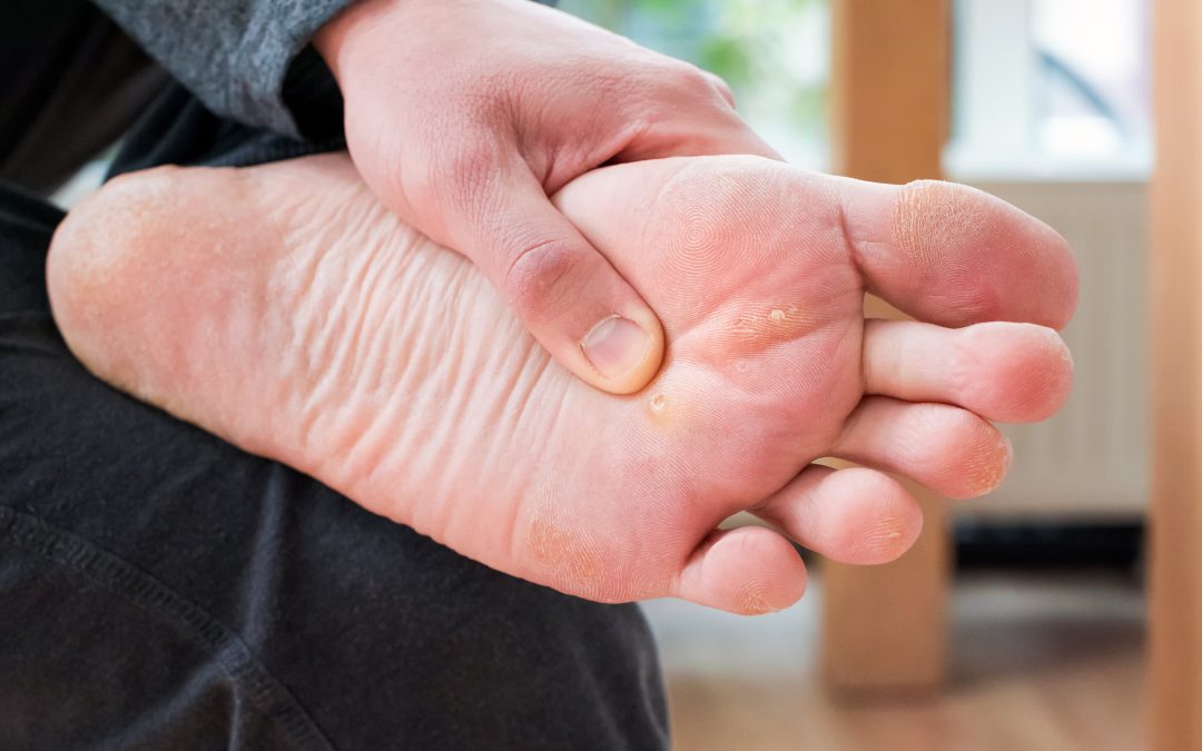 Say Goodbye to Pain Using Ingrown Toenail Treatment in Virginia Beach, VA, for Lasting Results