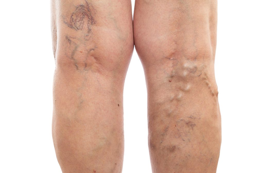 Personalized Care for Lasting Results Through Hemorrhoid Treatment in Baltimore, MD