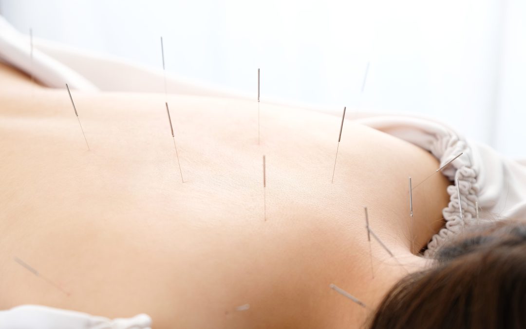 Find Holistic Wellness Education Through Acupuncture Courses Dallas Has Available Now