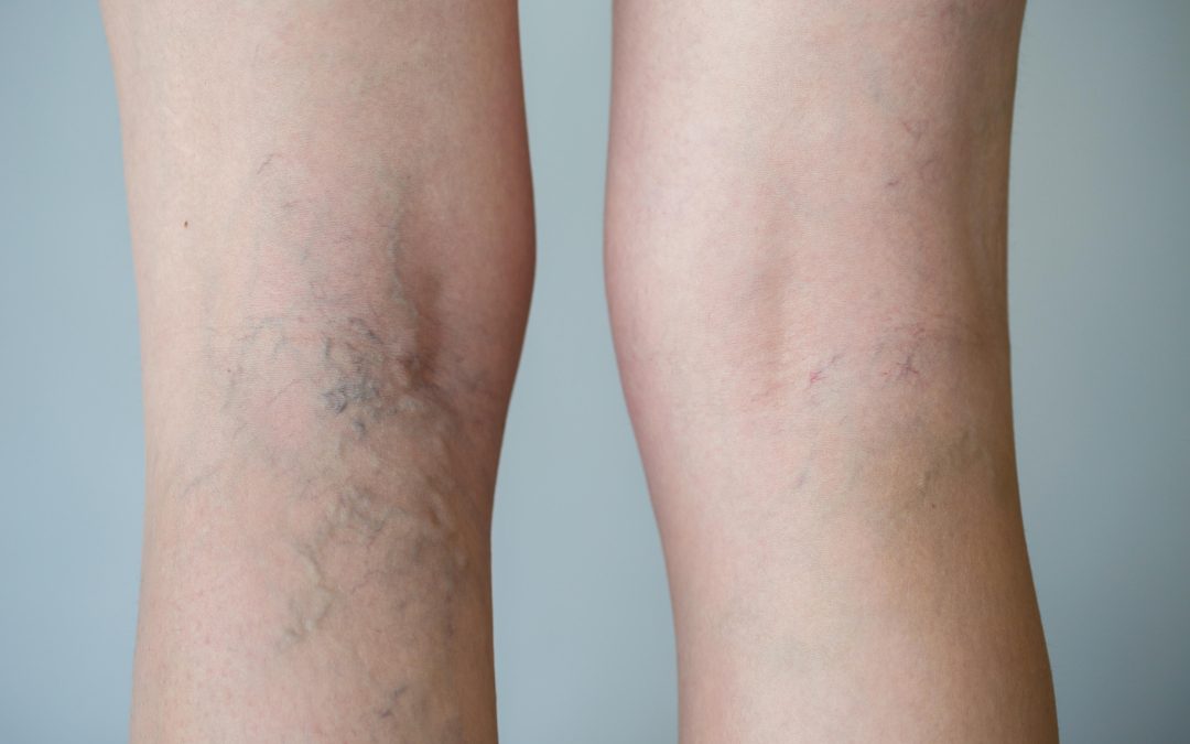 Pain Relief Solutions Start with Spider Veins Treatment in Virginia Beach, VA