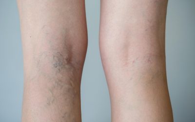 Pain Relief Solutions Start with Spider Veins Treatment in Virginia Beach, VA