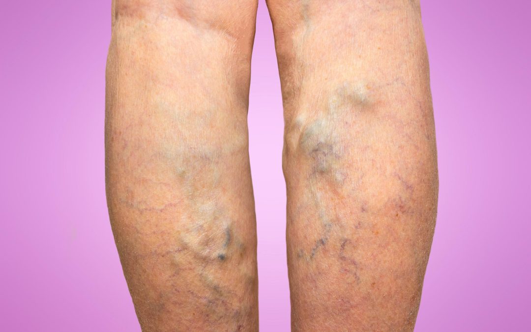 Improve Leg Appearance and Confidence through Varicose Veins Treatment in Richmond, VA