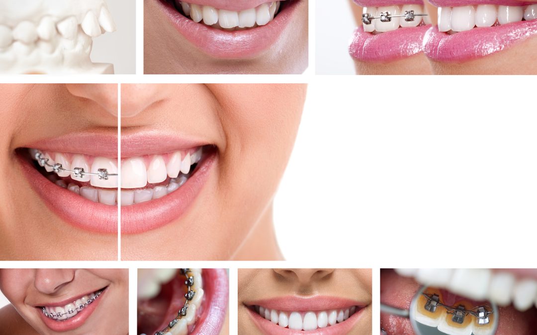 Get Fast and Reliable Results from Advanced Teeth Whitening Vista, CA Solutions